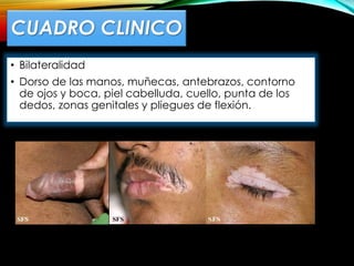 CUADRO CLINICO
• Bilateralidad
• Dorso de las manos, muñecas, antebrazos, contorno
de ojos y boca, piel cabelluda, cuello, punta de los
dedos, zonas genitales y pliegues de flexión.
 