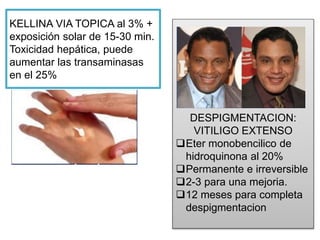 KELLINA VIA TOPICA al 3% +
exposición solar de 15-30 min.
Toxicidad hepática, puede
aumentar las transaminasas
en el 25%
DESPIGMENTACION:
VITILIGO EXTENSO
Eter monobencilico de
hidroquinona al 20%
Permanente e irreversible
2-3 para una mejoria.
12 meses para completa
despigmentacion
 
