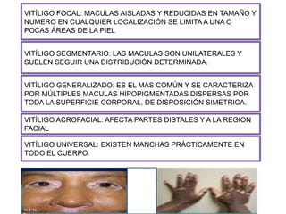 VITÍLIGO FOCAL: MACULAS AISLADAS Y REDUCIDAS EN TAMAÑO Y
NUMERO EN CUALQUIER LOCALIZACIÓN SE LIMITA A UNA O
POCAS ÁREAS DE LA PIEL
VITÍLIGO SEGMENTARIO: LAS MACULAS SON UNILATERALES Y
SUELEN SEGUIR UNA DISTRIBUCIÓN DETERMINADA.
VITÍLIGO GENERALIZADO: ES EL MAS COMÚN Y SE CARACTERIZA
POR MÚLTIPLES MACULAS HIPOPIGMENTADAS DISPERSAS POR
TODA LA SUPERFICIE CORPORAL, DE DISPOSICIÓN SIMETRICA.
VITÍLIGO ACROFACIAL: AFECTA PARTES DISTALES Y A LA REGION
FACIAL
VITÍLIGO UNIVERSAL: EXISTEN MANCHAS PRÁCTICAMENTE EN
TODO EL CUERPO
 