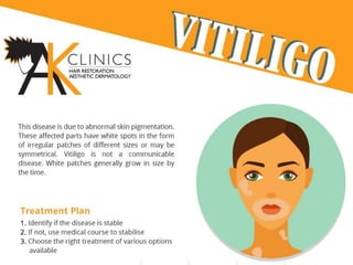 Vitiligo and It's Treatment