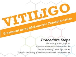 Vitiligo and It's Treatment