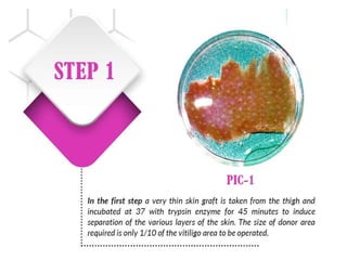 Vitiligo and It's Treatment