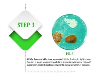 Vitiligo and It's Treatment