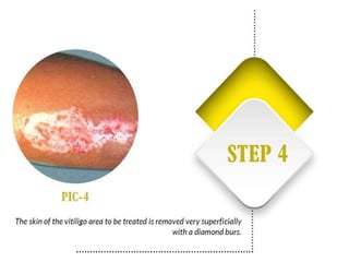 Vitiligo and It's Treatment