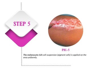 Vitiligo and It's Treatment
