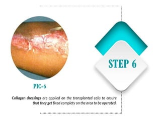 Vitiligo and It's Treatment