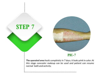 Vitiligo and It's Treatment