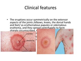 Mild Discoid Rash