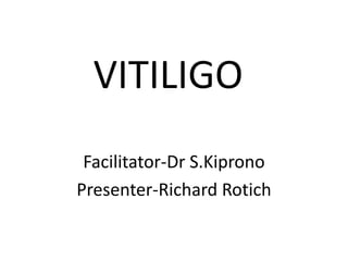 VITILIGO
Facilitator-Dr S.Kiprono
Presenter-Richard Rotich
 