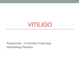VITILIGO
Prepared By :- Dr Monther Fadel Nagi
Dermatology Resident
 
