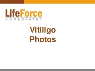 Vitiligo
Photos

 