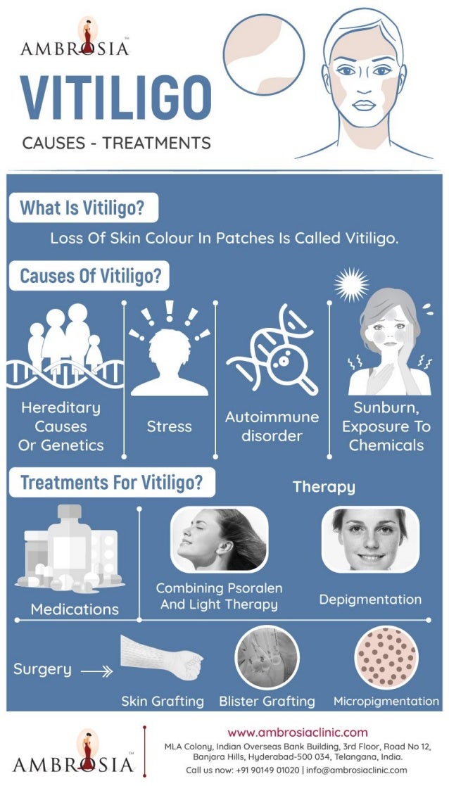 vitiligo treatment