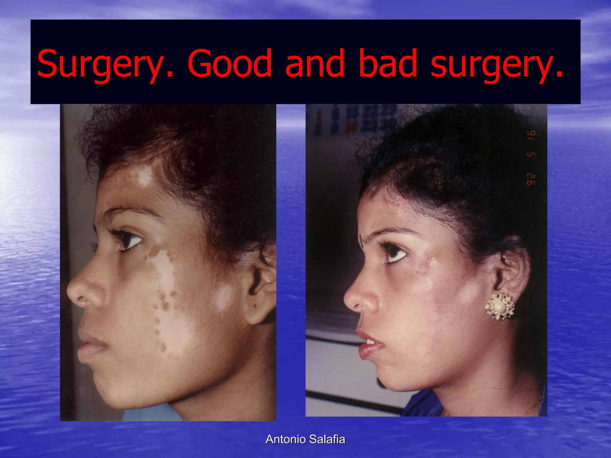 Surgery. Good and bad surgery.




            Antonio Salafia
 