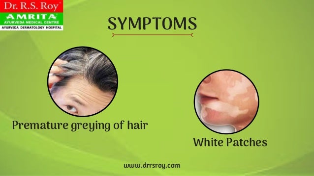 Ayurveda Treatment For Vitiligo In Kerala Best Ayurveda Skin Specia