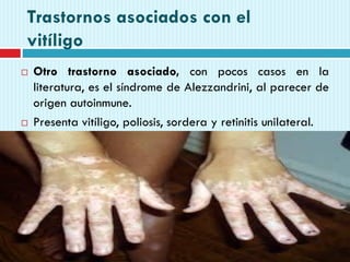 Trastornos asociados con el
vitíligo
 Otro trastorno asociado, con pocos casos en la
literatura, es el síndrome de Alezzandrini, al parecer de
origen autoinmune.
 Presenta vitíligo, poliosis, sordera y retinitis unilateral.
 