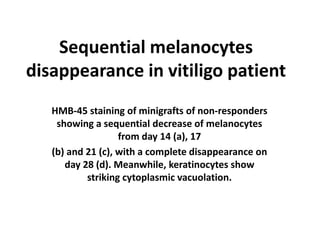 Sequential melanocytes
disappearance in vitiligo patient
HMB-45 staining of minigrafts of non-responders
showing a sequential decrease of melanocytes
from day 14 (a), 17
(b) and 21 (c), with a complete disappearance on
day 28 (d). Meanwhile, keratinocytes show
striking cytoplasmic vacuolation.
 