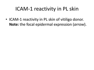ICAM-1 reactivity in PL skin
• ICAM-1 reactivity in PL skin of vitiligo donor.
Note: the focal epidermal expression (arrow).
 