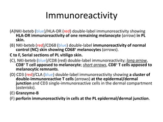Immunoreactivity
(A)NKI-beteb (blue)/HLA-DR (red) double-label immunoreactivity showing
HLA-DR immunoreactivity of one remaining melanocyte (arrow) in PL
skin.
(B) NKI-beteb (red)/CD68 (blue) double-label immunoreactivity of normal
control (NC) skin showing CD68+ melanocytes (arrows).
C to F, Serial sections of PL vitiligo skin.
(C), NKI-beteb (blue)/CD8 (red) double-label immunoreactivity; long arrow,
CD8+ T cell apposed to melanocyte; short arrows, CD8+ T cells apposed to
melanocytic remnants.
(D) CD3 (red)/CLA (blue) double-label immunoreactivity showing a cluster of
double-immunoreactive T cells (arrows) at the epidermal/dermal
junction and CD3 single-immunoreactive cells in the dermal compartment
(asterisks).
(E) Granzyme-B
(F) perforin immunoreactivity in cells at the PL epidermal/dermal junction.
 