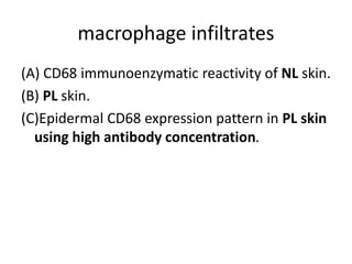 macrophage infiltrates
(A) CD68 immunoenzymatic reactivity of NL skin.
(B) PL skin.
(C)Epidermal CD68 expression pattern in PL skin
using high antibody concentration.
 