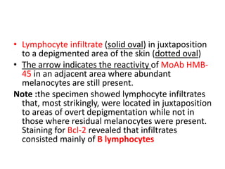 • Lymphocyte infiltrate (solid oval) in juxtaposition
to a depigmented area of the skin (dotted oval)
• The arrow indicates the reactivity of MoAb HMB-
45 in an adjacent area where abundant
melanocytes are still present.
Note :the specimen showed lymphocyte infiltrates
that, most strikingly, were located in juxtaposition
to areas of overt depigmentation while not in
those where residual melanocytes were present.
Staining for Bcl-2 revealed that infiltrates
consisted mainly of B lymphocytes
 
