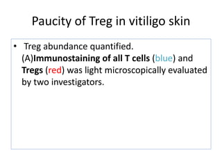 Paucity of Treg in vitiligo skin
• Treg abundance quantified.
(A)Immunostaining of all T cells (blue) and
Tregs (red) was light microscopically evaluated
by two investigators.
 