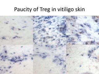 Paucity of Treg in vitiligo skin
 