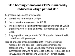Skin homing chemokine CCL22 is markedly
reduced in vitligo patient skin
Representative images are given for
A. control and non-lesional vitiligo
B. frozen skin immunostained for CCL22.
C. The data reveal a significantly reduced abundance of CCL22
expressing non-lesional and intra-lesional vitiligo skin (P <
0.05).
D. Treg migration in response to CCL22 was also determined in
control and vitiligo samples .
Treg abundance among migrated CD4+ lymphocytes was
measured in the absence (spontaneous migration) or
presence of CCR4 ligand CCL22. Treg migration data were
summarized showing no difference in the % Treg responding
to CCL22 among control and vitiligo CD4+ lymphocytes.
 