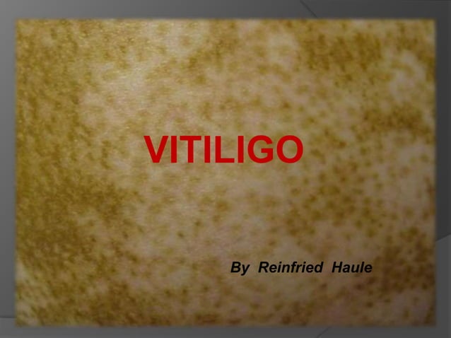 Vitiligo presentation | PPTX