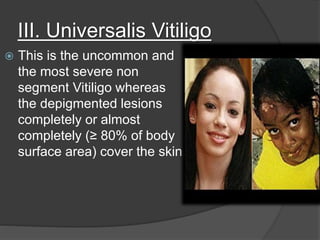 III. Universalis Vitiligo
 This is the uncommon and
the most severe non
segment Vitiligo whereas
the depigmented lesions
completely or almost
completely (≥ 80% of body
surface area) cover the skin.
 