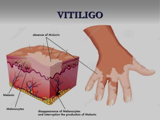 VITILIGO
 