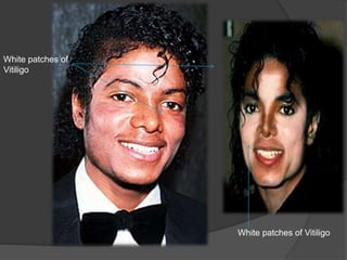 White patches of
Vitiligo
White patches of Vitiligo
 