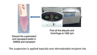 The suspension is applied topically over dermabraded recipient site
 