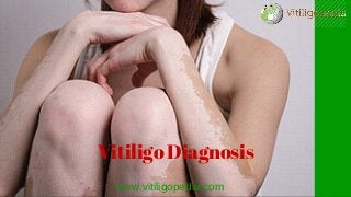 www.vitiligopedia.com
Vitiligo Diagnosis
 
