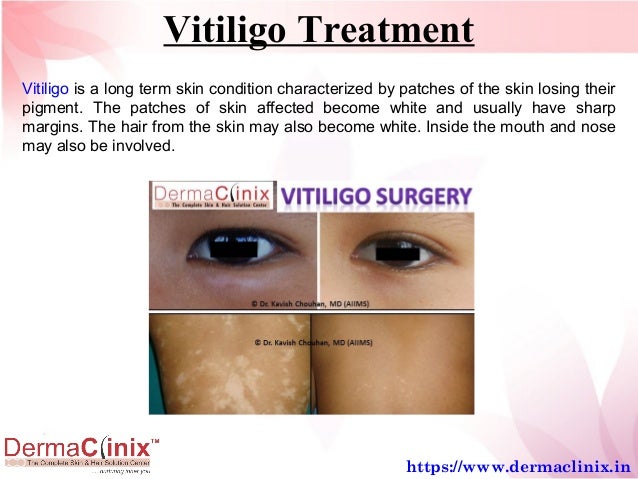 Best Vitiligo Treatment Leucoderma In Delhi Ncr
