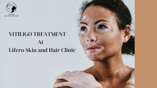 VITILIGO TREATMENT
At
Lifero Skin and Hair Clinic
 