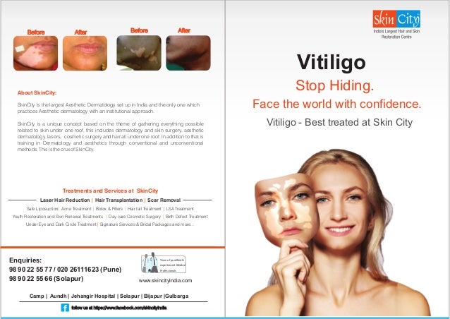 best vitiligo treatment in world