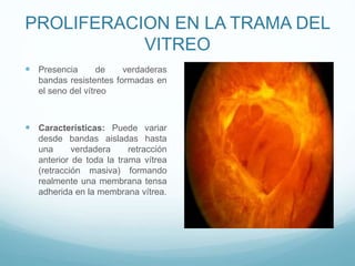PROLIFERACION EN LA TRAMA DEL
VITREO
 Presencia

de
verdaderas
bandas resistentes formadas en
el seno del vítreo

 Características: Puede variar
desde bandas aisladas hasta
una
verdadera
retracción
anterior de toda la trama vítrea
(retracción masiva) formando
realmente una membrana tensa
adherida en la membrana vítrea.

 