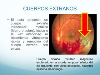 CUERPOS EXTRANOS
 Si

está presente un
cuerpo
extraño
intraocular
metálico
(hierro o cobre), tóxico o
tal vez infeccioso se
recomienda vitrectomía
rápida y remoción del
cuerpo
extraño
con
pinzas.
Cuerpo
extraño
metálico
magnético
enclavado en la arcada temporal inferior del
ojo izquierdo, con vítrea adyacente, hialoides
aplicada. hemorragia

 