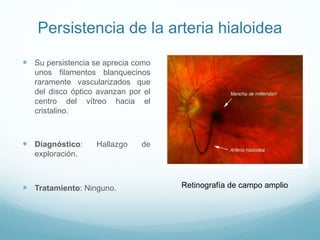 Persistencia de la arteria hialoidea
 Su persistencia se aprecia como
unos filamentos blanquecinos
raramente vascularizados que
del disco óptico avanzan por el
centro del vítreo hacia el
cristalino.

 Diagnóstico:

Hallazgo

de

exploración.

 Tratamiento: Ninguno.

Retinografía de campo amplio

 