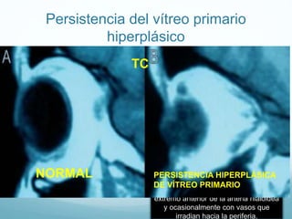 Persistencia del vítreo primario
hiperplásico
Persistencia de vítreo primario hiperplásico; en
segmento anterior se observa
adherencias iridocristalineanas

NORMAL

catarata

TC
y

Estudio biomicroscópico del OIzq

MANCHA DE MITTENDORF una
PERSISTENCIA HIPERPLÁSICA
mancha blanquecida por detrás del
DE VÍTREO PRIMARIO

cristalino que corresponde al resto del
extremo anterior de la arteria hialoidea
y ocasionalmente con vasos que
irradian hacia la periferia.

 