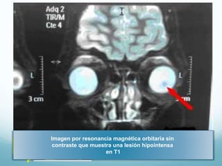 QUISTES
 Raros.
 Afectan ambos sexos.

Quiste vítreo anterior con fondo de
ojo normal

 Exploración: Se ven como
vesículas
grisáceas
en
ocasiones con algunos grumos
pigmentarios y discretas estrías
en su pared que flotan
libremente en un sector limitado
del vítreo.

 Tratamiento: No requieren.

Imagen por resonancia magnética orbitaria sin
contraste que muestra una lesión hipointensa
en T1

 