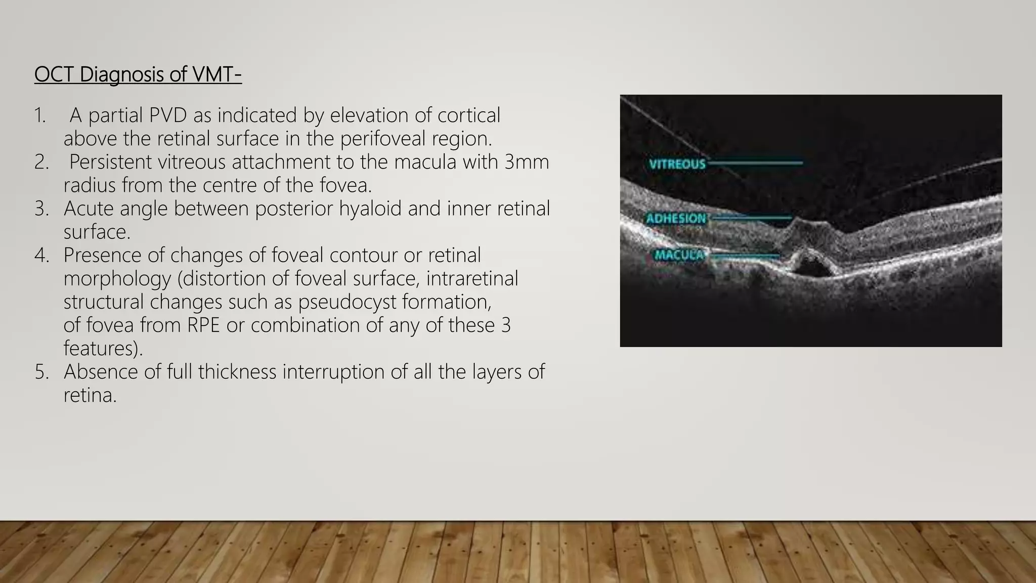 Vmt In Retina Vitreo macular interface disorder | PPTX