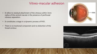 Vitreo-macular adhesion
• It refers to residual attachment of the vitreous within 3mm
radius of the central macula in the presence of perifoveal
vitreous separation.
• It constitutes a stage in a dynamic process of PVD .
• There is no tractional component and no distortion of the
foveal contour.
 