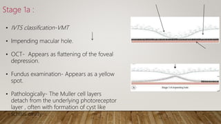 Vmt Classification Vitreo macular interface disorder | PPTX