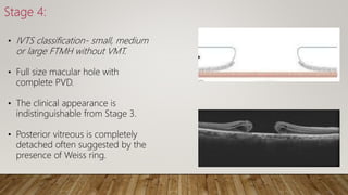 Vitreo macular interface disorder | PPTX