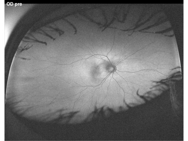 Laser-Vitreolyse bei Glaskörpertrübungen / Teil 3