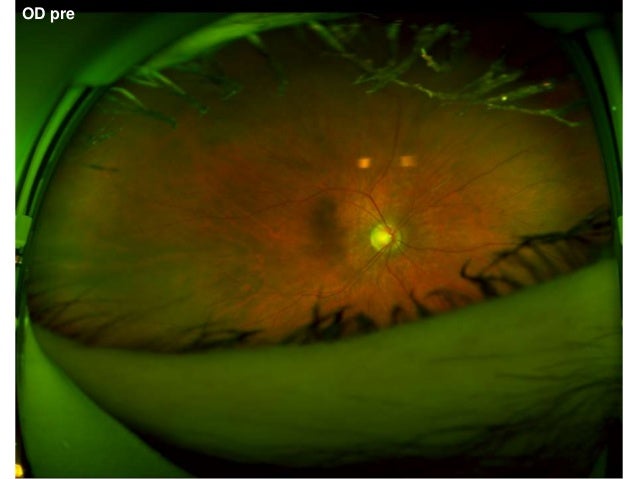 Laser-Vitreolyse bei Glaskörpertrübungen / Teil 3