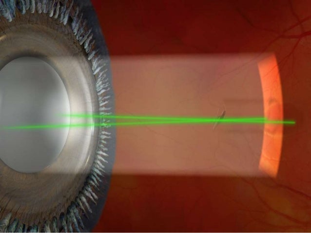 Laser-Vitreolyse – Pro