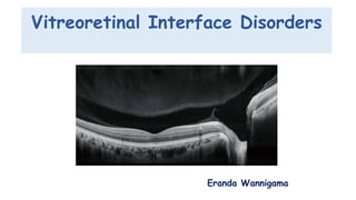 Vitreoretinal Interface Disorders
Eranda Wannigama
 