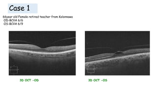 Case 1
66year old Female retired teacher from Kolonnawa
OD-BCVA 6/6
OS-BCVA 6/9
3D OCT -OD 3D OCT -OS
 